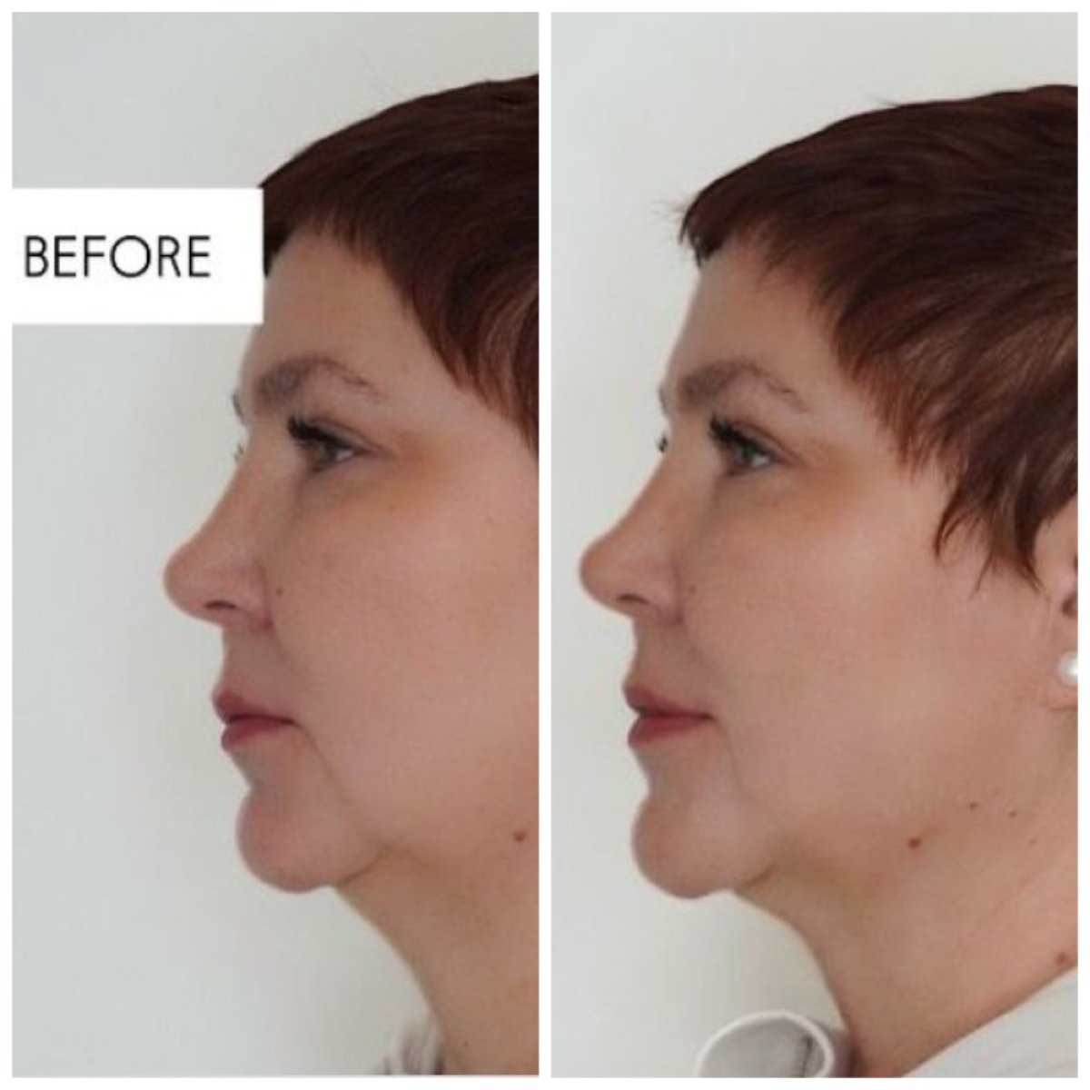 Результати до і після безопераційної підтяжки обличчя в Altos Clinic, покращення контуру