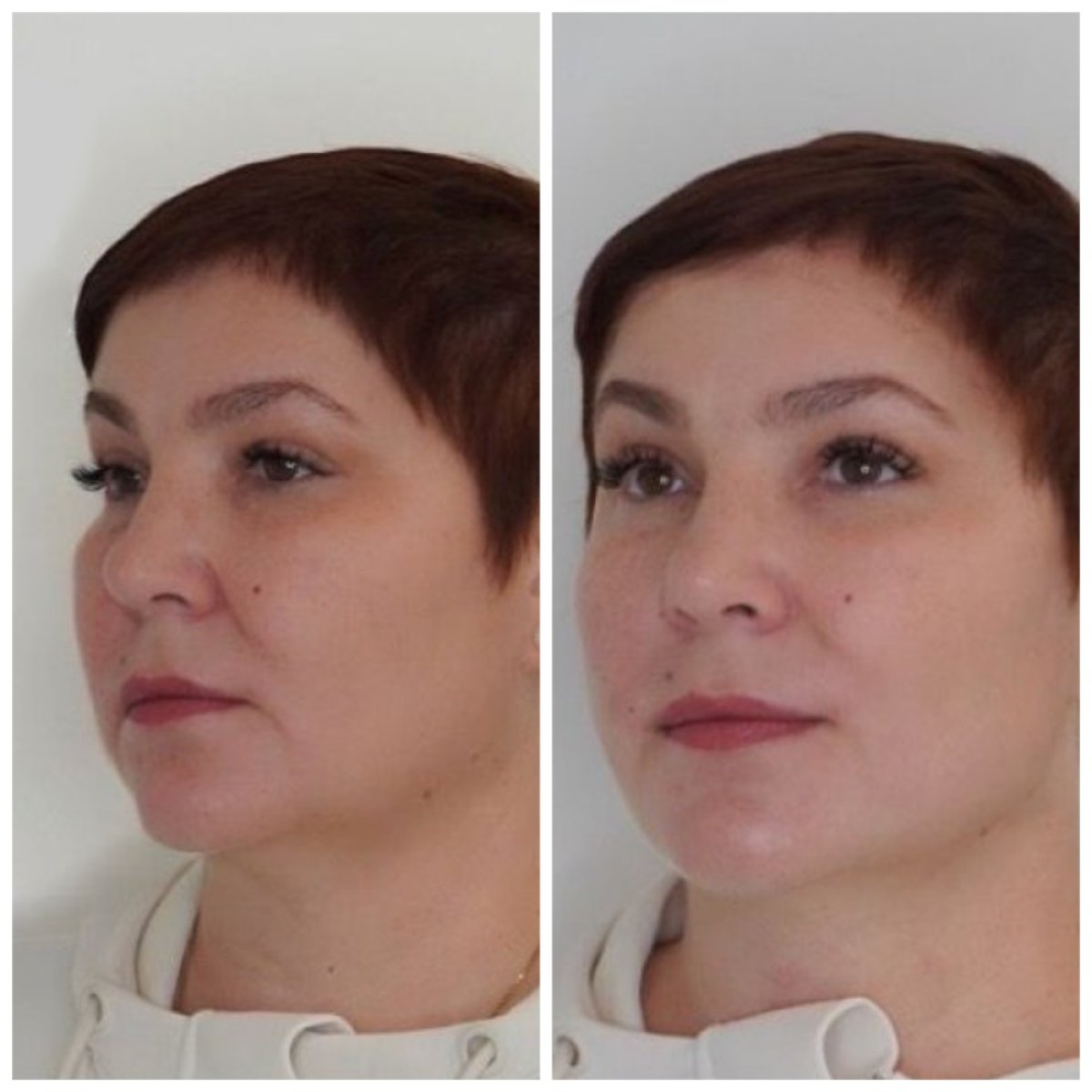 Результати до і після безопераційної підтяжки обличчя в Altos Clinic, покращення контуру
