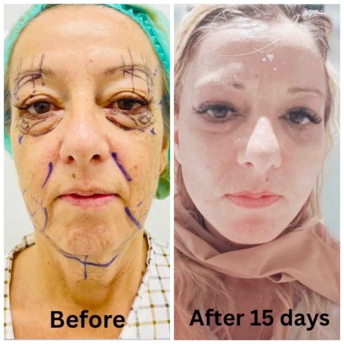 Resultado de lifting facial antes y después de 15 días en DGB Clinic, rejuvenecimiento visible
