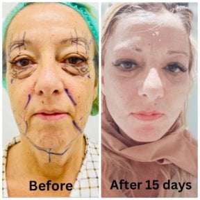 Resultado de lifting facial antes y después de 15 días en DGB Clinic, rejuvenecimiento visible