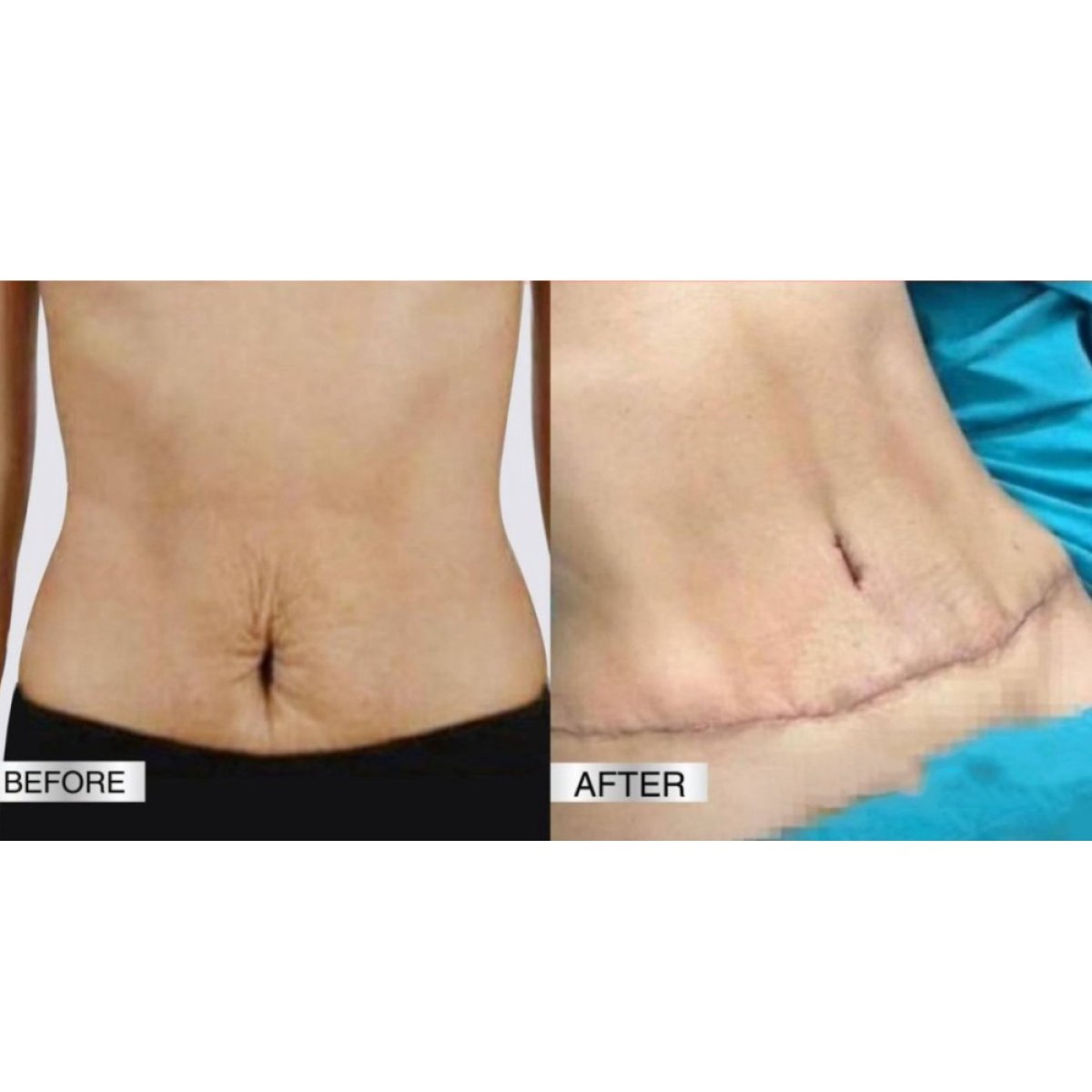 Vorher-nachher-Ergebnis der Bauchdeckenstraffung in DGB Clinic, verbesserte Bauchkontur