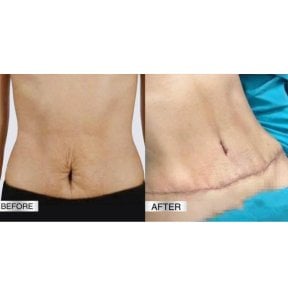 نتائج شد البطن قبل وبعد في DGB Clinic، تحسين واضح لشكل البطن