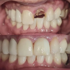 Vorher-nachher-Ergebnisse der Zirkonkrone bei SoftDentalCare Clinic, Lächeln wiederhergestellt