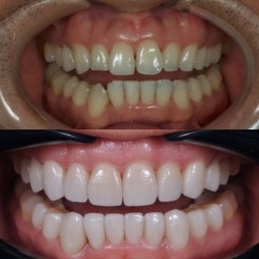 Before and after porcelain veneer results at Kitcha Dental Clinic, smile makeover transformation