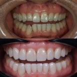 Before and after porcelain veneer results at Kitcha Dental Clinic, smile makeover transformation