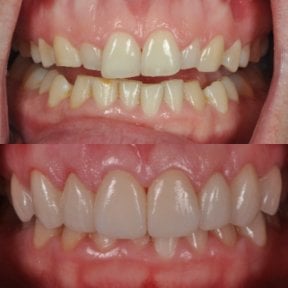 Before and after porcelain veneer results at Kitcha Dental Clinic – smile transformation
