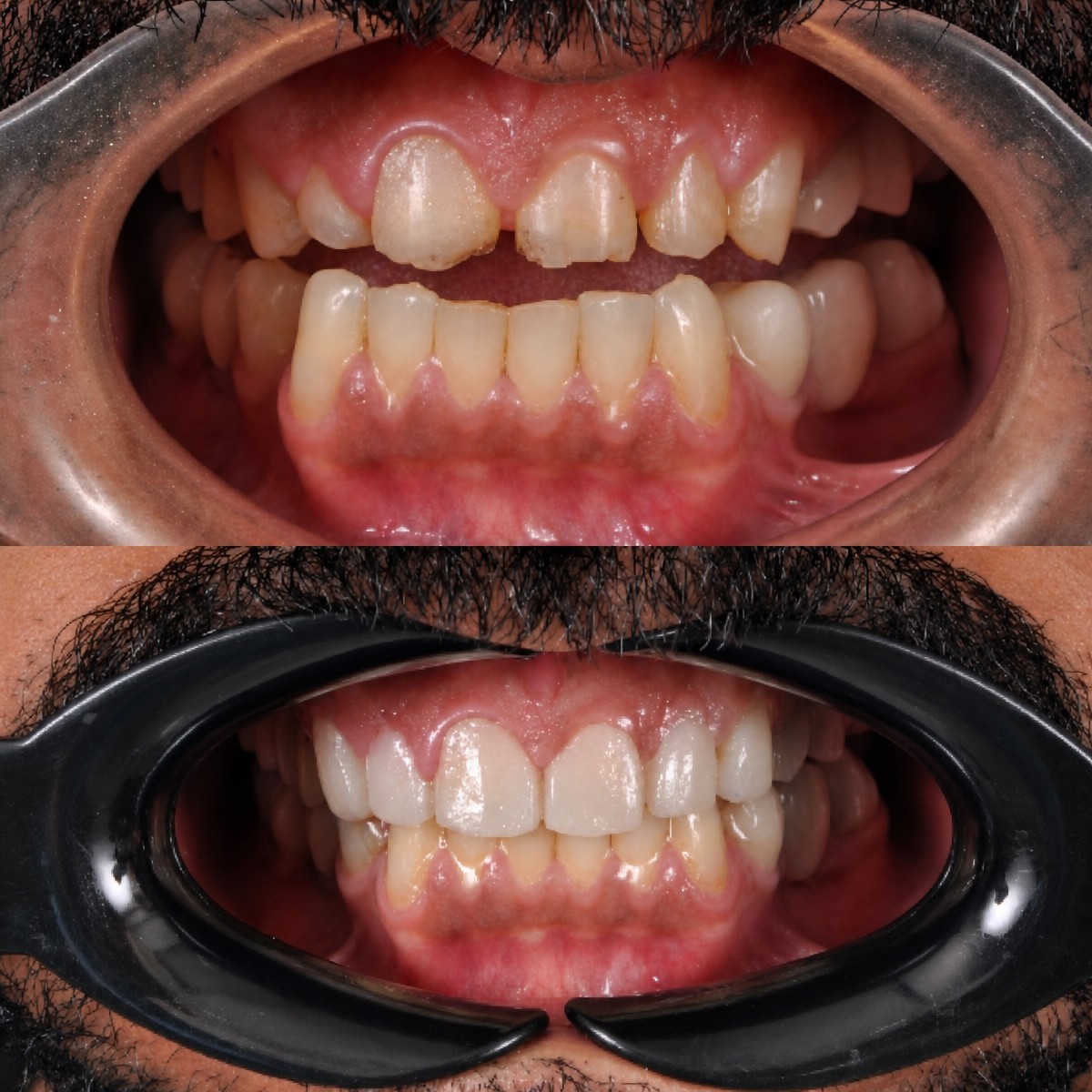 Resultados antes y después de coronas de zirconia en Kitcha Dental Clinic, mejora de la sonrisa