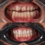 Vorher-nachher-Ergebnisse Zirkonkrone bei Kitcha Dental Clinic, verbesserte Zahnästhetik