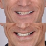 Vorher-nachher-Ergebnis Zirkonkrone bei Kitcha Dental Clinic, verbesserte Zahnästhetik