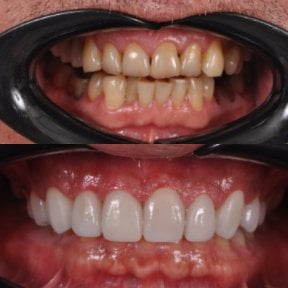 Before and after porcelain veneer results at Kitcha Dental Clinic, smile makeover transformation