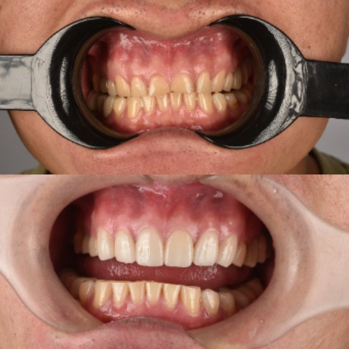 Resultados antes y después de carillas de porcelana en Kitcha Dental Clinic, sonrisa mejorada