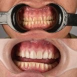 Before and after porcelain veneer results at Kitcha Dental Clinic, improved smile aesthetics