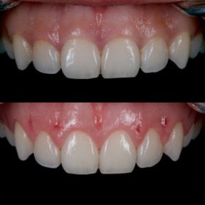 Before and after gingivectomy results at Kitcha Dental Clinic, improved gum contour visible