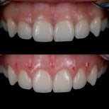 Before and after gingivectomy results at Kitcha Dental Clinic, improved gum contour visible