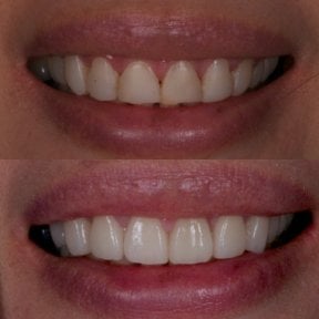 Before and after porcelain veneer results at Kitcha Dental Clinic, improved smile aesthetics