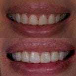 Before and after porcelain veneer results at Kitcha Dental Clinic, improved smile aesthetics