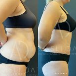 Vorher-nachher-Liposuktionsergebnis bei Liv Hospital Ulus, sichtbare Bauchkonturverbesserung