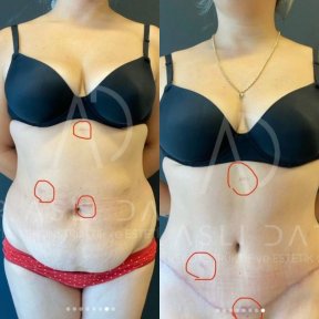 Vorher-nachher-Ergebnis der Fettabsaugung bei Liv Hospital Ulus, sichtbare Bauchkontur