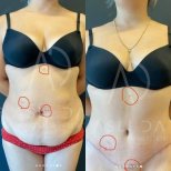 Vorher-nachher-Ergebnis der Fettabsaugung bei Liv Hospital Ulus, sichtbare Bauchkontur