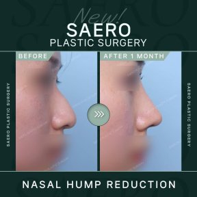 Before and after nasal hump reduction at SAERO Plastic Surgery, rhinoplasty result after 1 month