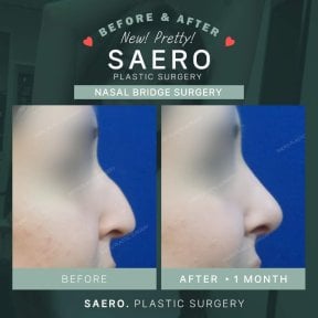 Before and after nasal bridge surgery results at SAERO Plastic Surgery, improved nose profile