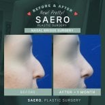Before and after nasal bridge surgery results at SAERO Plastic Surgery, improved nose profile