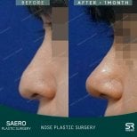Before and after open rhinoplasty results at SAERO Plastic Surgery, improved nose profile