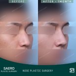 Before and after open rhinoplasty results at SAERO Plastic Surgery, nose reshaping outcome