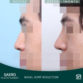 Before and after open rhinoplasty at SAERO Plastic Surgery, nasal hump reduction result
