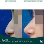 Before and after open rhinoplasty results at SAERO Plastic Surgery, natural nose reshaping