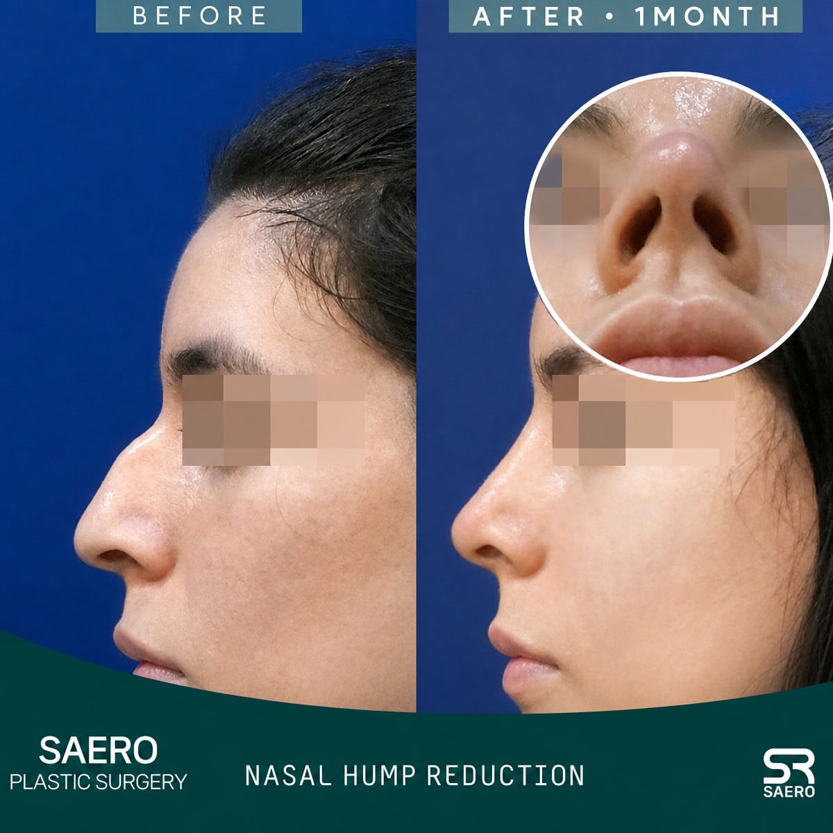 Resultados antes y después de rinoplastia abierta en SAERO Plastic Surgery, reducción de caballete nasal