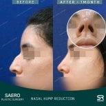 Before and after open rhinoplasty at SAERO Plastic Surgery, nasal hump reduction result