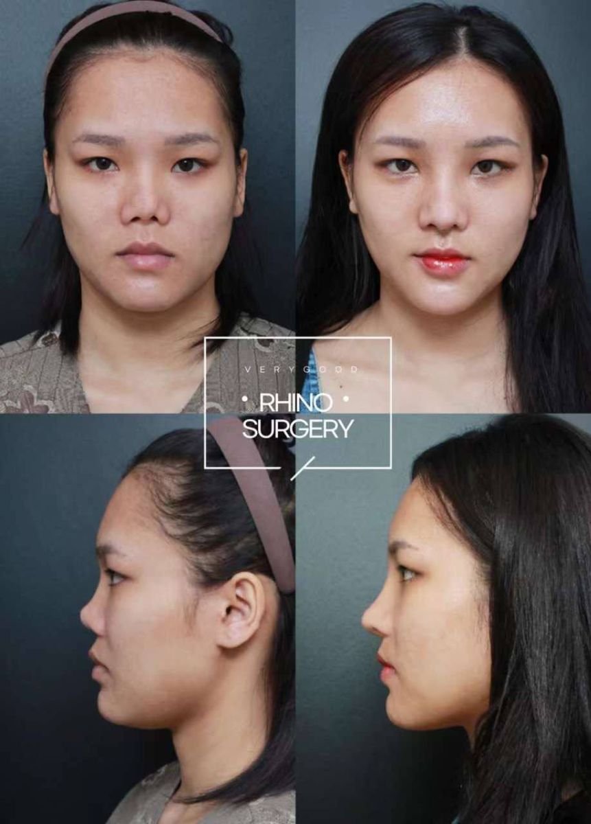 نتائج قبل وبعد عملية تجميل الأنف المفتوحة في VG Plastic Surgery، تحسين شكل الأنف