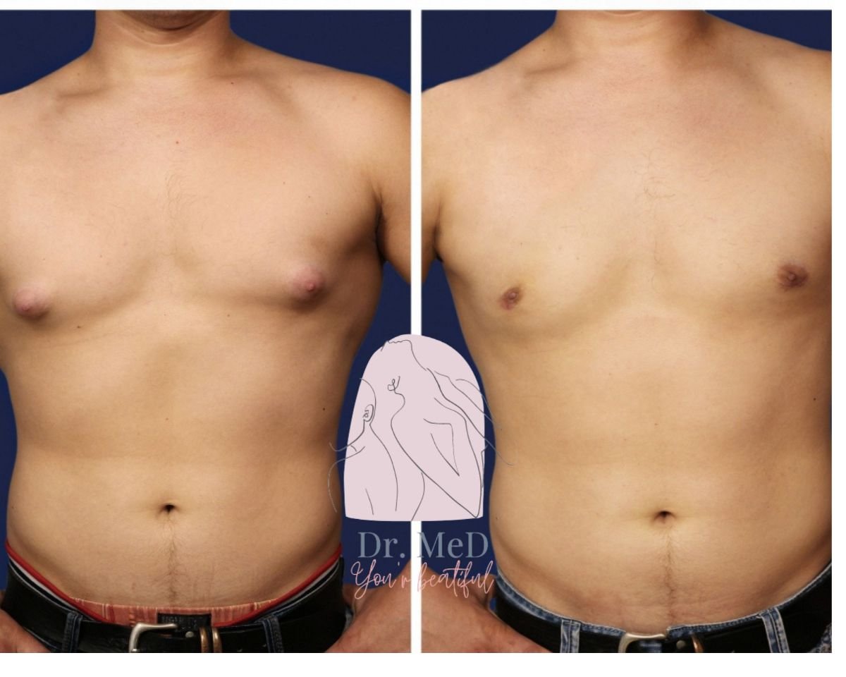 نتائج قبل وبعد جراحة التثدي في Dr. MED – تحسين شكل صدر الرجل