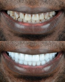Before and after veneers at ÜMRAN TIP MERKEZİ – smile transformation with whiter teeth result