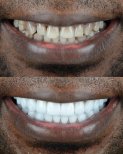 Before and after veneers at ÜMRAN TIP MERKEZİ – smile transformation with whiter teeth result