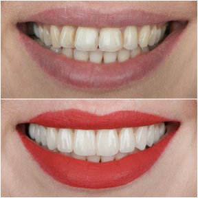 Before and after veneers at ÜMRAN TIP MERKEZİ, smile makeover with whiter, even teeth result