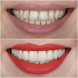 Before and after veneers at ÜMRAN TIP MERKEZİ, smile makeover with whiter, even teeth result