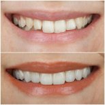 Before and after veneers at ÜMRAN TIP MERKEZİ – smile makeover with natural-looking results