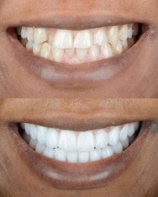 Vorher-nachher-Veneers bei ÜMRAN TIP MERKEZİ, strahlend weißes Lächeln Ergebnis
