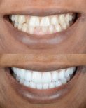 Vorher-nachher-Veneers bei ÜMRAN TIP MERKEZİ, strahlend weißes Lächeln Ergebnis
