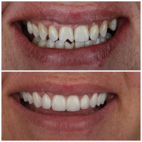 Vorher-nachher-Veneers bei ÜMRAN TIP MERKEZİ – natürliches Lächeln-Ergebnis