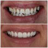 Vorher-nachher-Veneers bei ÜMRAN TIP MERKEZİ – natürliches Lächeln-Ergebnis