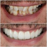Vorher-nachher-Veneers bei ÜMRAN TIP MERKEZİ, sichtbare Zahnaufhellung und neues Lächeln