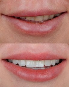 Vorher-nachher Veneers bei ÜMRAN TIP MERKEZİ, natürliches Lächeln-Ergebnis