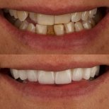 Vorher-nachher Veneers bei ÜMRAN TIP MERKEZİ – natürlich weiße Zähne