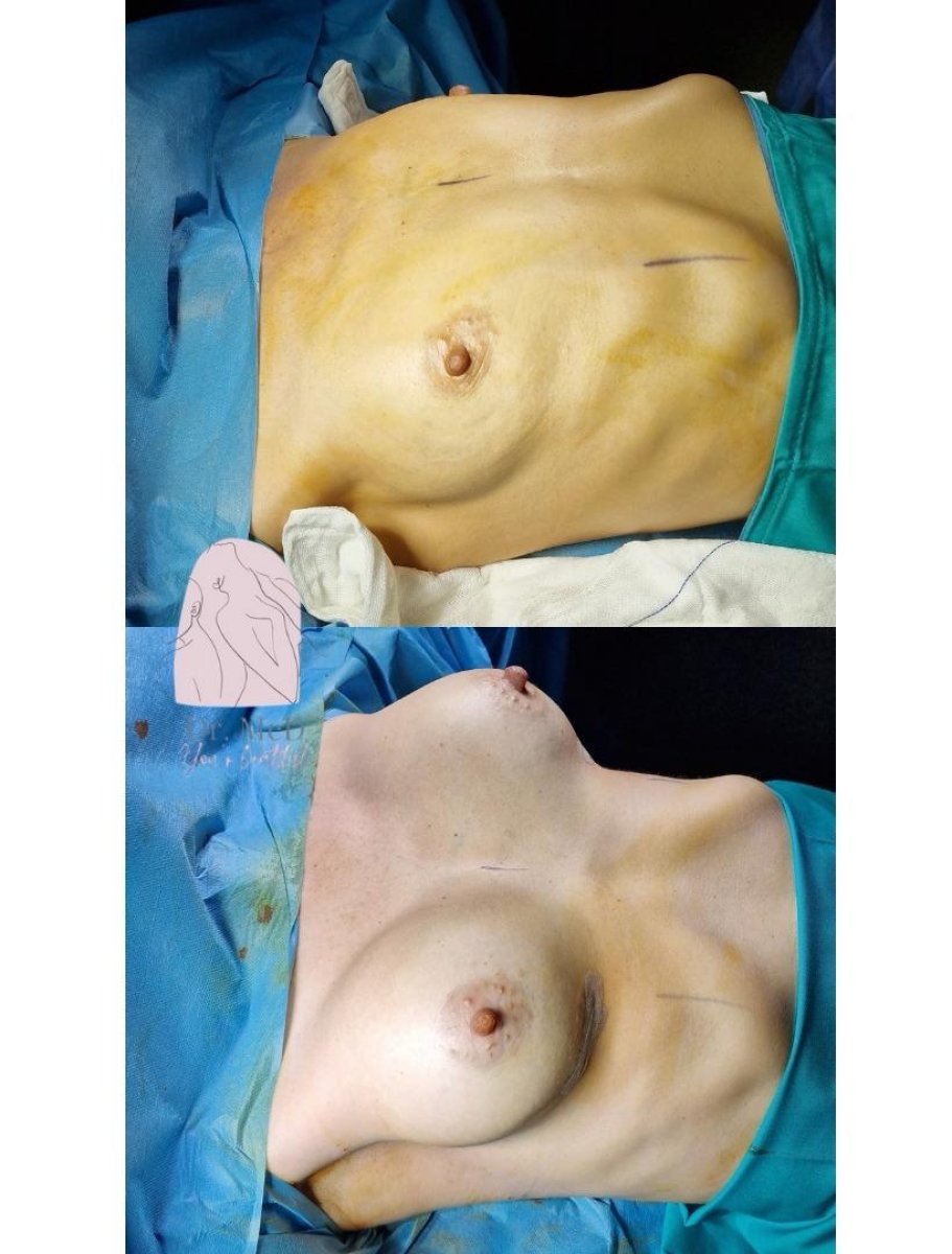 Vorher-nachher-Ergebnis Bruststraffung bei Dr. MED – verbesserte Brustform und Kontur