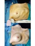 Before and after breast lift results at Dr. MED – improved breast shape and contour