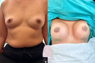 Before and after breast lift results at Dr. MED – improved breast shape and contour