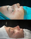 نتائج تجميل الأنف قبل وبعد في ÜMRAN TIP MERKEZİ، إعادة تشكيل الأنف وتحسين المظهر